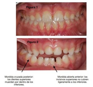 y 5. Boca cerrada y boca abierta, apiñamiento dental. Mordida cruzada.